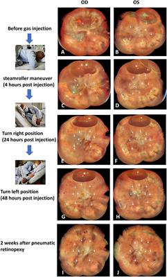 Case report: Advanced modified pneumatic retinopexy for treating simultaneous bilateral rhegmatogenous retinal detachment